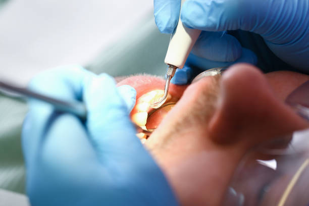 Best Emergency Dentist for Knocked-Out Tooth in Puyallup, WA