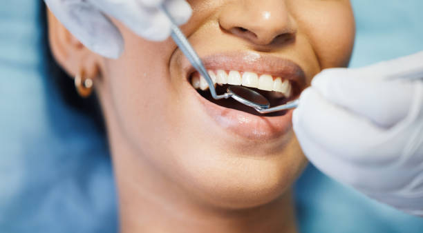 Best Emergency Dentist for Lost Fillings or Crowns in Puyallup, WA